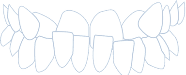 Underbite-teeth